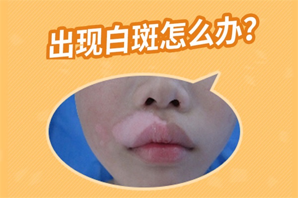 肢端型白癜風(fēng)、白癜風(fēng)要怎么治療
