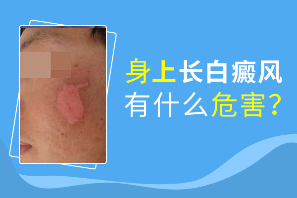 白癜風(fēng)患者懷孕有影響嗎